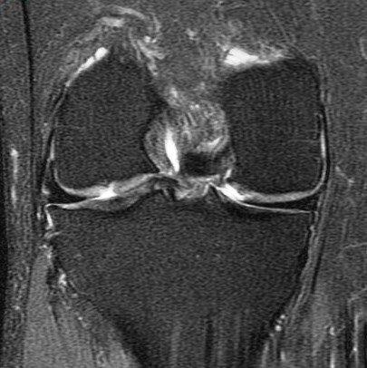 Figure 2 for case Button osteophyte filling chondral defect